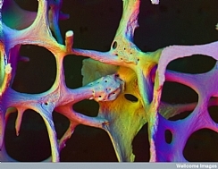 בריחת סידן מהעצמות - טיפול, תסמינים ודרכי מניעה