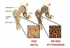 בדיקת צפיפות עצם לאבחון דלדול העצם ולמניעת אוסטאופורוזיס